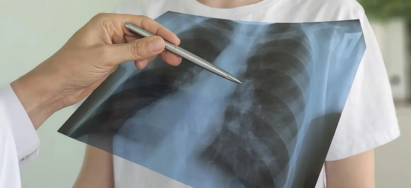 O variantă genetică rară crește riscul de cancer pulmonar și la nemătuitori